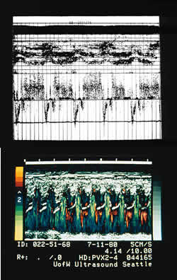 Early black and white echocardiography images (top) didn't provide much information.  Today's color Doppler echocardiography scans (bottom) show not only biological structures, but blood flow, giving physicians much more information when they diagnose heart problems.  Images courtesy Dr. J. Geoffrey Stevenson